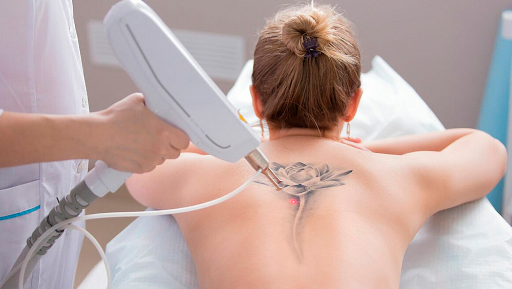 Эффективность лазерного удаления тату: важные детали и советы для пациентов.
