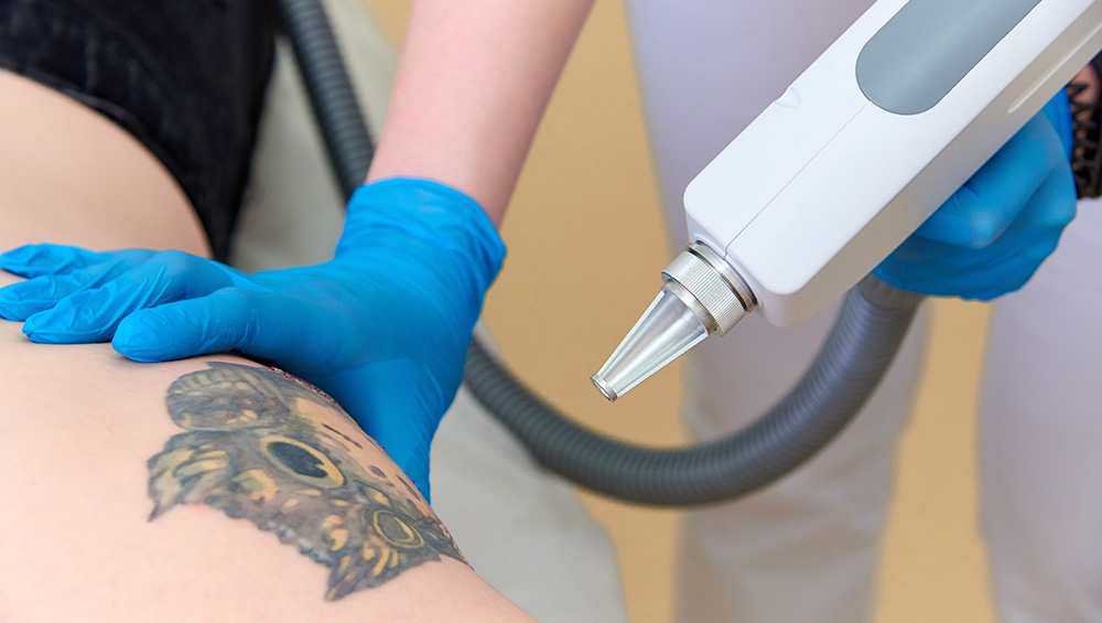 Лазерное удаление татуировок: преимущества и нюансы данной процедуры.