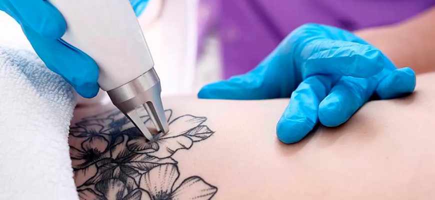 Все, что нужно знать о процессе лазерного удаления татуировок.